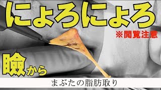 まぶたから、にょろにょろ【瞼の脂肪を落とす手術動画】