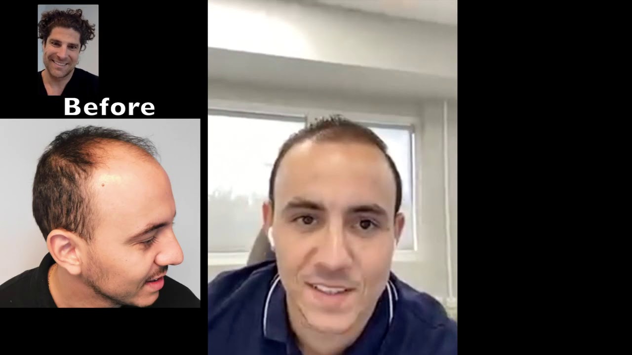 Natural Hair Transplants Do you live in Jacksonville, Florida? YouTube