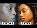 Skincare Routine for Acne & Dark Spots | Glowy Skin! - Destiny Lashae Makeup