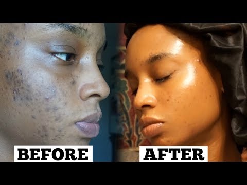 Skincare Routine for Acne & Dark Spots | Glowy Skin! - Destiny Lashae Makeup