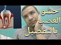 حشو العصب المميزات و العيوب و الطريقه و طرق المحافظه علي حشو العصب