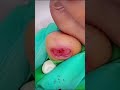 LITTLE PINKY TOE PERMANENT FUNGAL NAIL REMOVAL 2023 BY FAMOUS PODIATRIST MISS FOOT FIXER