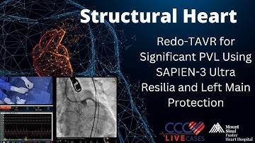 Redo-TAVR for Significant PVL Using SAPIEN-3 Ultra Resilia and Left Main Protection