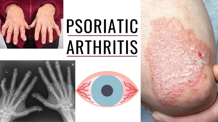 Understanding Psoriatic Arthritis