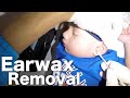 This is How to Remove Earwax from Junior&#39;s Ear