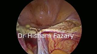 Huge fibroid uterus Total laparoscopic hysterectom     استئصال الرحم بالمنظار