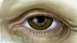 Cataract - Small Incision Surgery  PreOp® Patient Education Medical Video