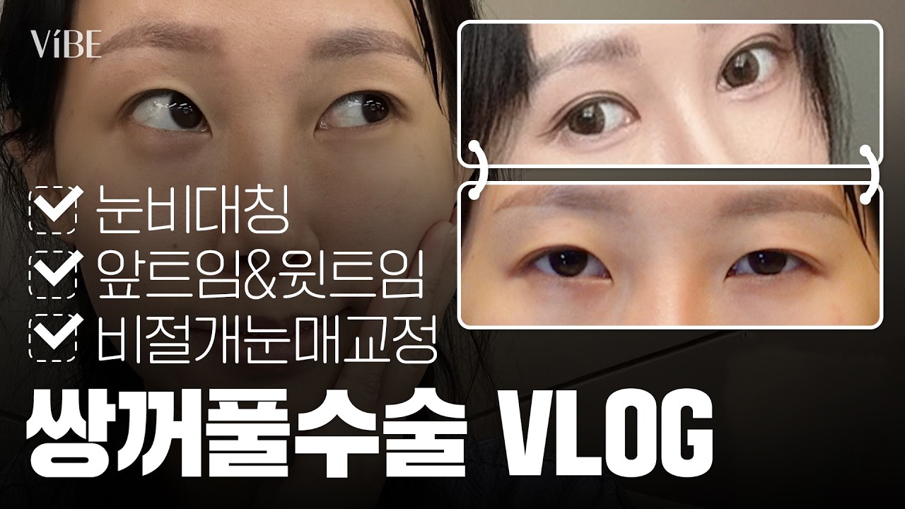 Double Eyelid Surgery VLOG] Why I flew from China to Korea