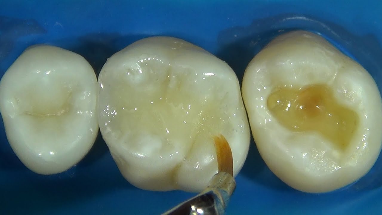 Resina Composta Termoviscosa – tipo Bulk Fill (Thermoviscous composite resin - Bulk Fill)