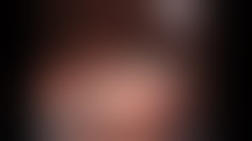 Robotic Left Upper Lobectomy - NO FISSURE; VATS approach