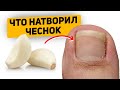 Как я мазала ногти чесноком и что произошло с грибком ногтей (важно знать)