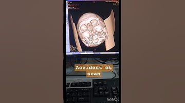 3D Accidental ct scans.#trendingshorts #viralvideo #viralshorts #public #pop #music