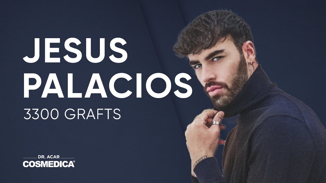 Hair Transplant Result of Jesus Palacios Cosmedica Dr. Acar YouTube