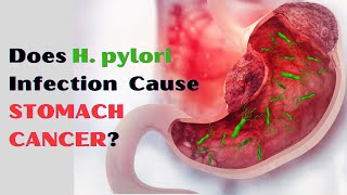 H. pylori | Ulcer | Gastritis | H. pylori Symptoms | Urdu/Hindi | 3D Animation