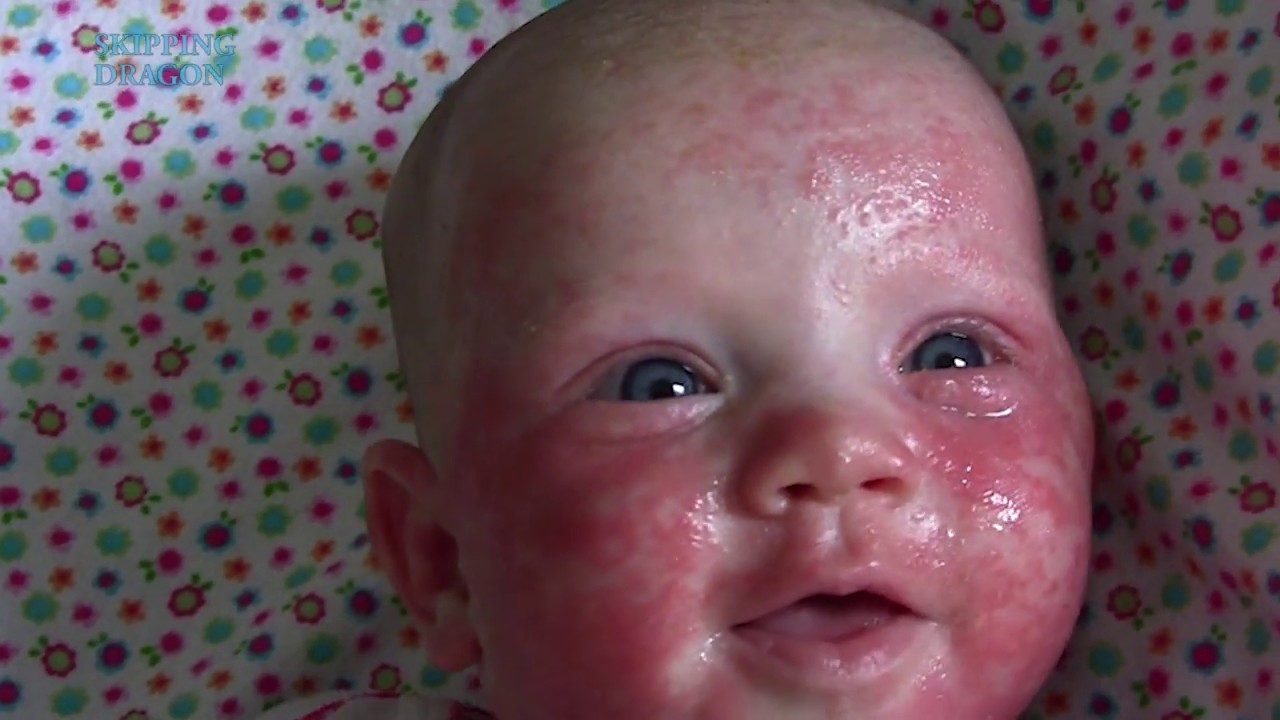 Baby Eczema Acne On Newborns Face Food Allergy Symptoms Youtube