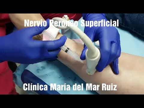 Video: Neuropatia Del Nervo Peroneo