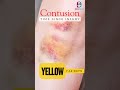 Time since injury- contusion