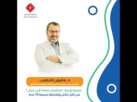 تفتيت حصى استئصال حصاه قرن غزال من خلال الكلى وتفتيتها