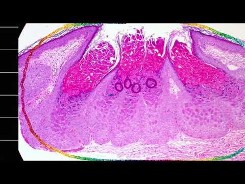 Video: Molluscum Contagiosum - Vad är Det? Behöver Jag Behandlas? På Vilket Sätt?