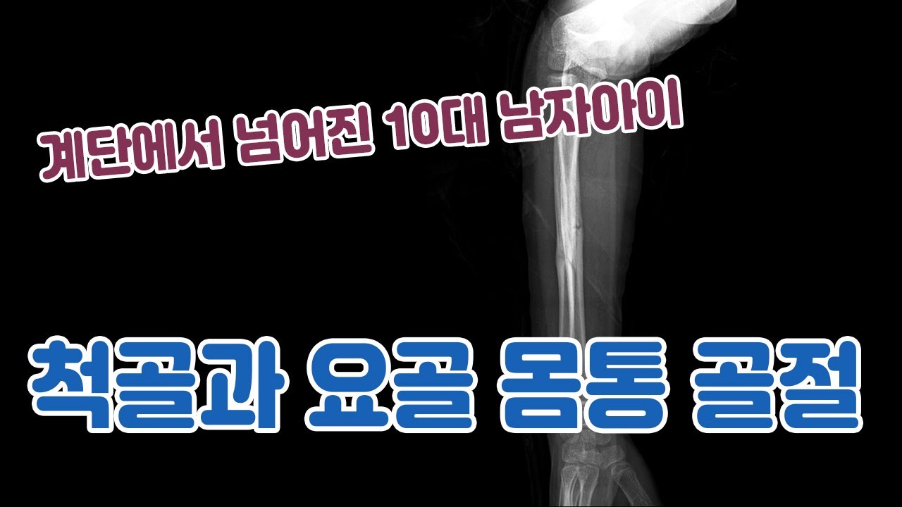 척골과 요골 몸통 골절(소아) - YouTube