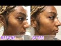 VLOG Mask Acne Is REAL Trying The Diamond Glow Facial To Instantly Help Congestion IamLindaElaine 
