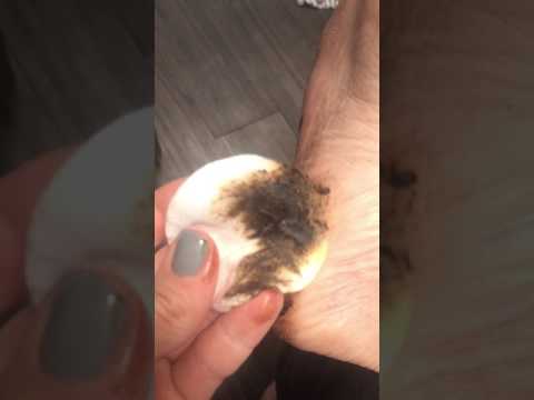 How to get beach tar off your feet!