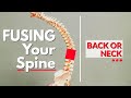 The Problem with Fusing Your Spine- Back or Neck