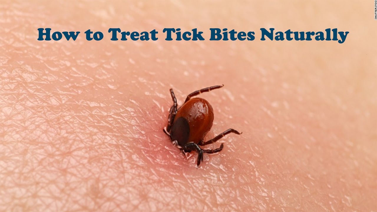 How To Treat Tick Bites Naturally How To Remove A Tick Bite And