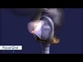 Urologie  hifu  thrapie focale du cancer prostatique  par focal one