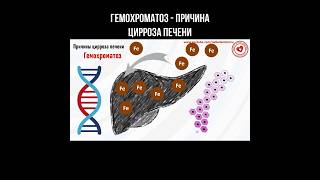 Гемохроматоз - причина цирроза печени #гемохроматоз #циррозпечени #цирроз #печень