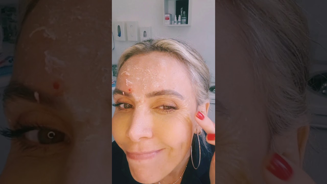 O que dá pra fazer com 50 unidades de botox?