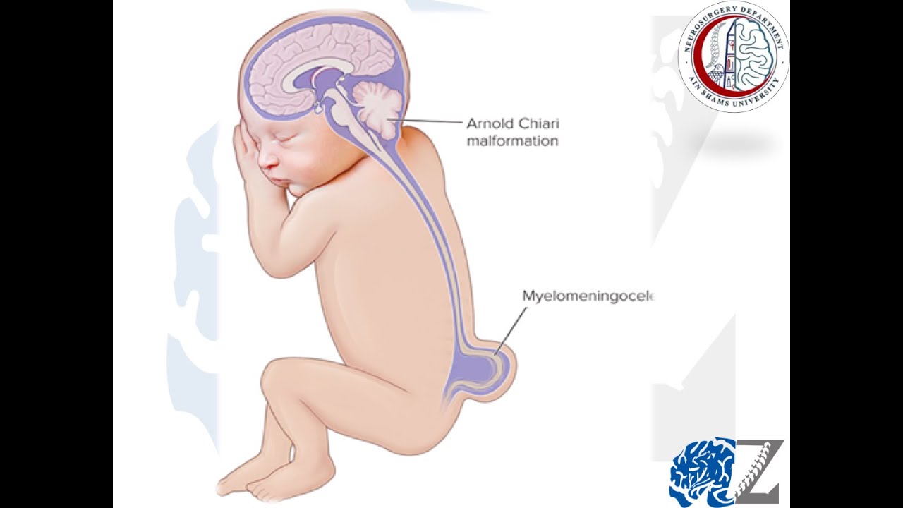 Spina Bifida and Myelomeningeocele (Part 2)  تشقق العمود الفقري و الكيس السحائي النخاعي