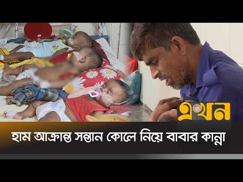 চট্টগ্রামে হাম-ডেঙ্গুর ভ/য়াবহ প্রকোপ, এক বেডে ৩-৪ শিশু | Measles Effects | Dengue | Chattogram |