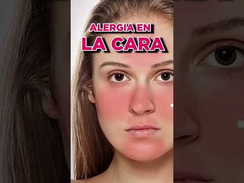 Video: 3 formas de deshacerse del sarpullido en la cara