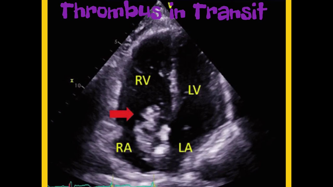 Thrombus in transit inside the Right Atrium Echocardiography , 3D