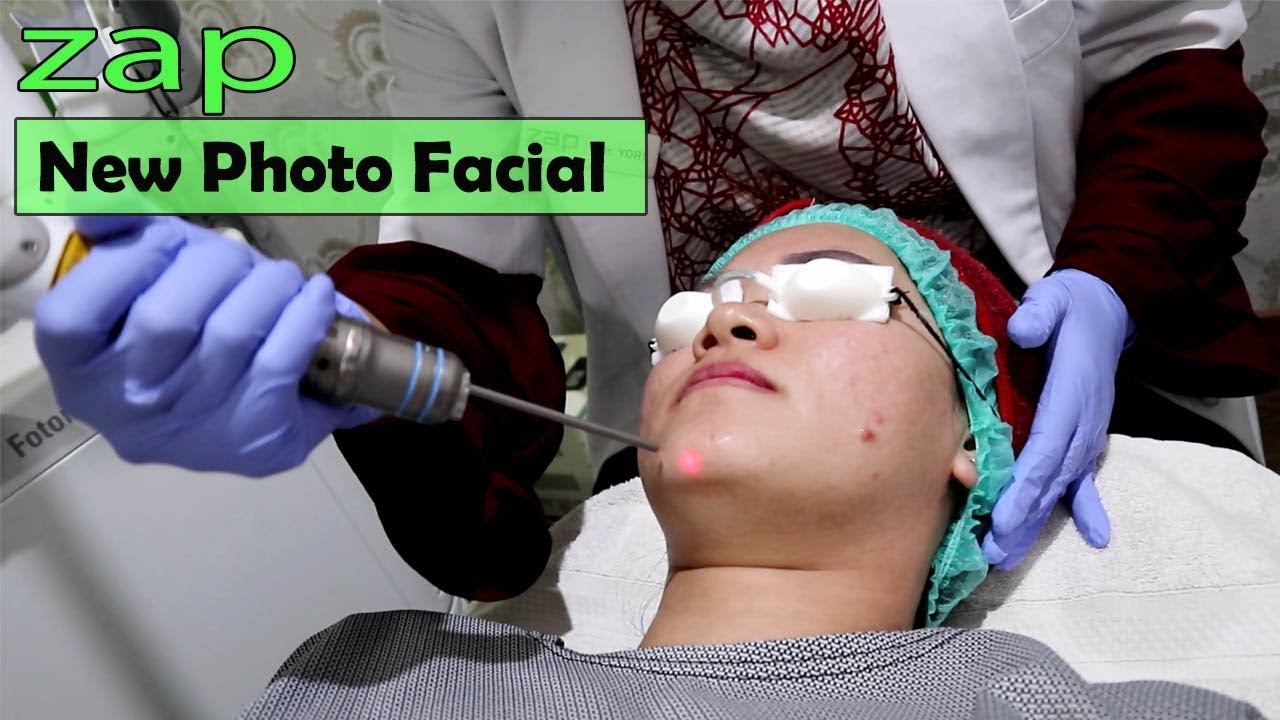 Perawatan Menghilangkan Bekas Jerawat Zap New Photo Facial Cantikjamannow Youtube