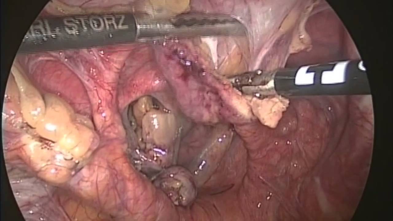 Que es una hernia estrangulada