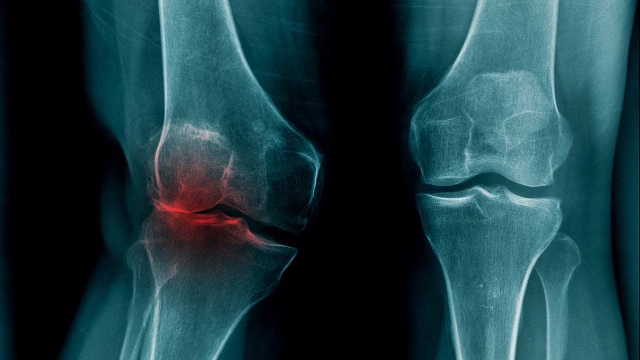 Update Probleme mit Knie-Arthrose