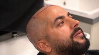 Hair transplant day at Feriduni Hair Clinic