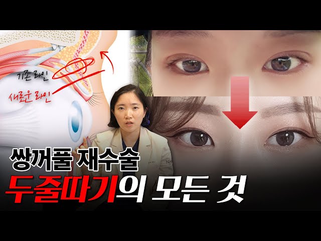 쌍꺼풀 재수술 두줄따기2️⃣ 제대로 하면 인상까지 달라집니다! | 재수술 노하우 공개✨