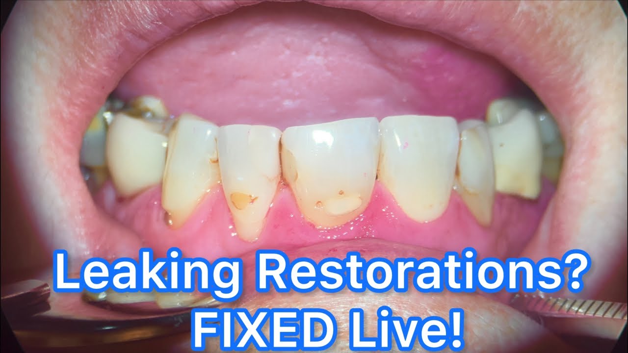 Replacing Old Leaking Composites | Advanced Aesthetic Dentistry with Tokuyama Omnichroma (Live)