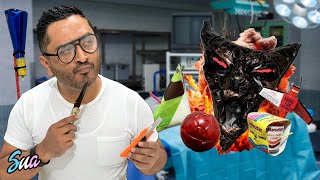Cuetes Qué Tienen Adentro? - Cirugía Con El Doctor Sua