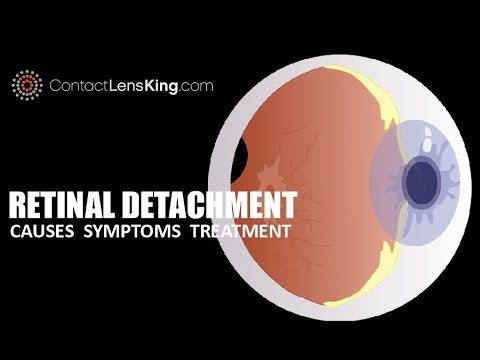 Retinal Detachment Causes, Symptoms and Treatments
