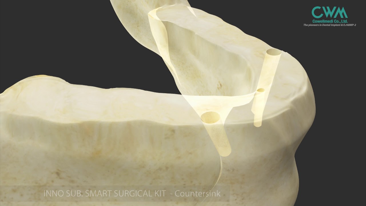 AO4 Implant Restoration using COWELL® Implant Solution YouTube