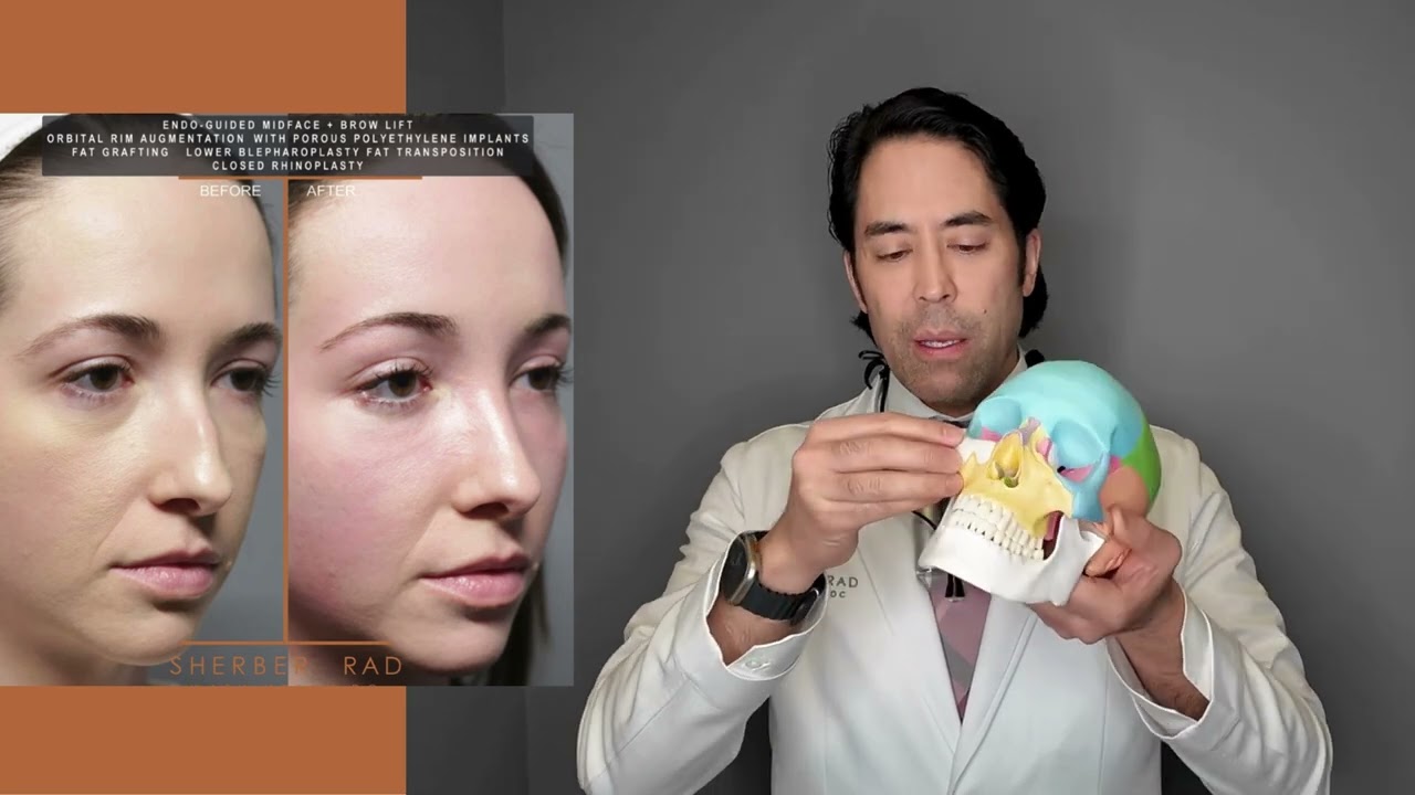 MIDFACE IMPLANTS