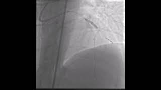 Video 22.4 Yan Dal Tel Kopması