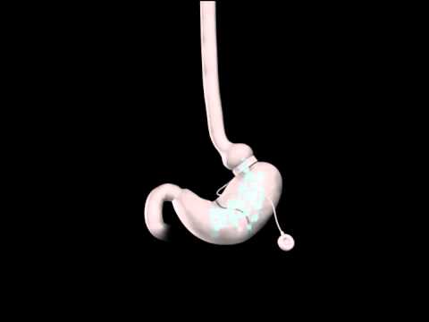 Adjustable Gastric Banding - The Lap-Band Procedure