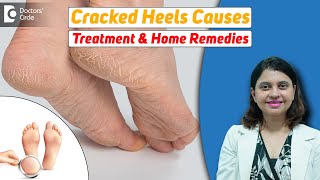 10 Home Remedies for CRACKED HEELS | Magical Cracked Heel Remedies-Dr. Amee Daxini | Doctors' Circle