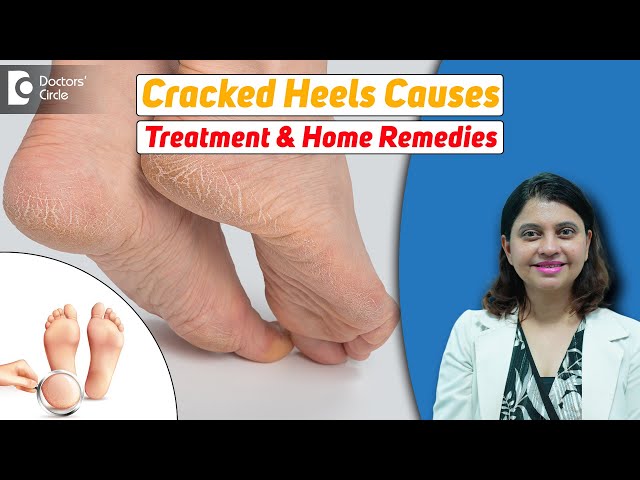 How to Prevent Cracked Heels? - Dr Venus