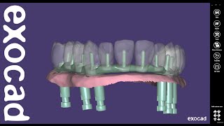 exocad Quick Guide: Using the Cutback Library "Retentions"